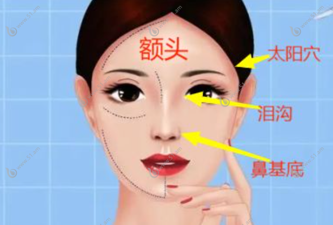 素妍骨胶原轮廓针好用适合填充哪些部位？